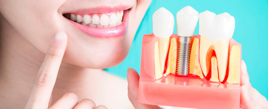 ¿Cuánto duran los implantes dentales?